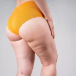 Lipedema | Dra. Gabriela Godoy