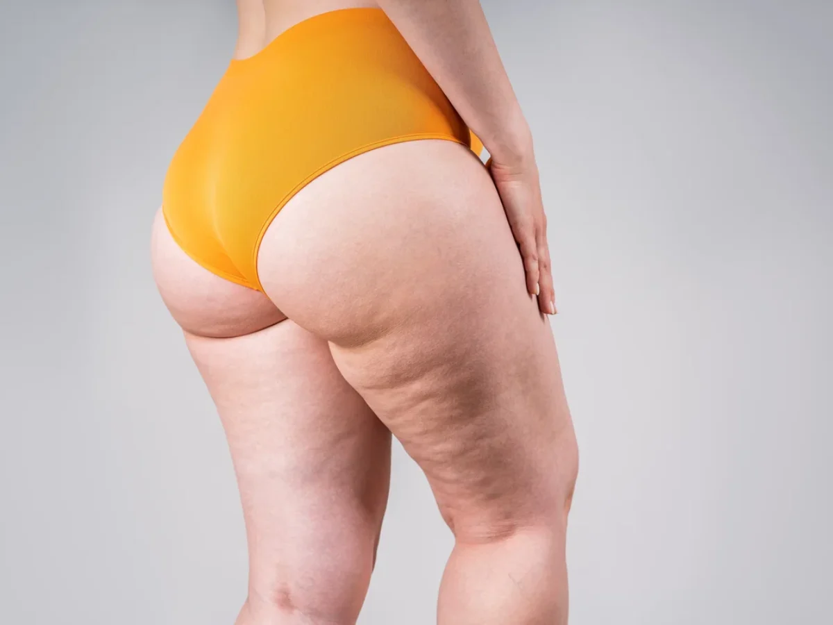 Lipedema | Dra. Gabriela Godoy